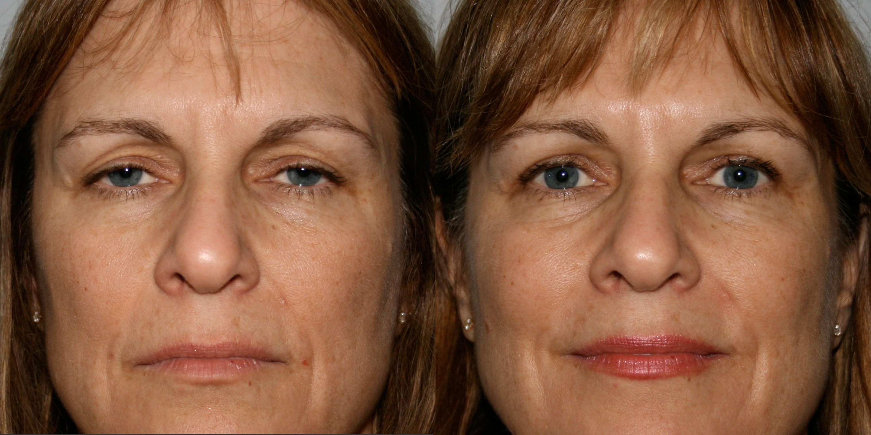 Before and After eyelid lift blepharoplasty photos