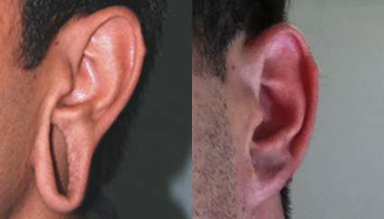 Stretched Earlobe Repair before and after