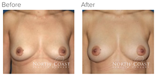 Before and After Natural Breast Augmentation San Diego, Oceanside, CA and Carlsbad, CA