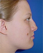 Nose Surgery (Rhinoplasty)