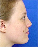 Nose Surgery (Rhinoplasty)