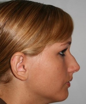 Nose Surgery (Rhinoplasty)