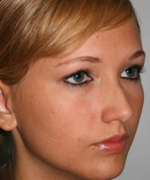 Nose Surgery (Rhinoplasty)