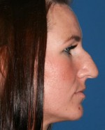 Nose Surgery (Rhinoplasty)