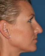 Nose Surgery (Rhinoplasty)