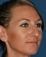 Nose Surgery (Rhinoplasty)