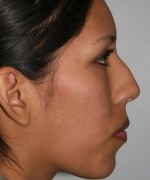 Nose Surgery (Rhinoplasty)