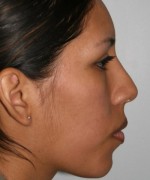 Nose Surgery (Rhinoplasty)