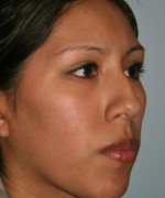 Nose Surgery (Rhinoplasty)