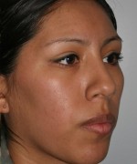 Nose Surgery (Rhinoplasty)