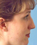 Nose Surgery (Rhinoplasty)