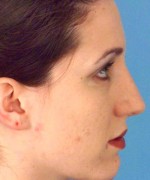 Nose Surgery (Rhinoplasty)
