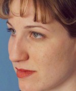 Nose Surgery (Rhinoplasty)