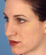 Nose Surgery (Rhinoplasty)