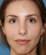 Nose Surgery (Rhinoplasty)