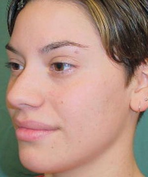 Nose Surgery (Rhinoplasty)