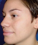 Nose Surgery (Rhinoplasty)