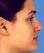 Nose Surgery (Rhinoplasty)