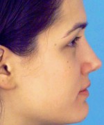 Nose Surgery (Rhinoplasty)