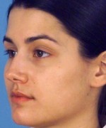 Nose Surgery (Rhinoplasty)