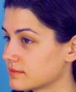 Nose Surgery (Rhinoplasty)