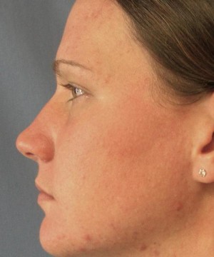 Nose Surgery (Rhinoplasty)