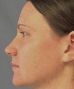 Nose Surgery (Rhinoplasty)