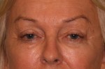 Eyelid Surgery