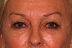 Eyelid Surgery