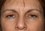 Eyelid Surgery