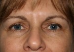 Eyelid Surgery