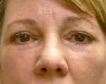 Eyelid Surgery