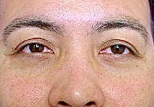 Eyelid Surgery