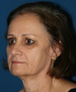 Face Lift
