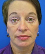 Face Lift