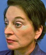 Face Lift