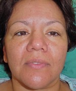 Face Lift