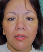 Face Lift
