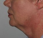 Neck Lift