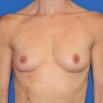 Breast Augmentation
