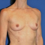 Breast Augmentation