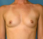 Breast Augmentation