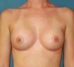 Breast Augmentation