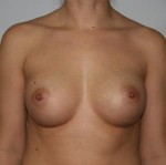 Breast Augmentation