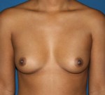 Breast Augmentation