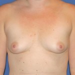 Breast Augmentation