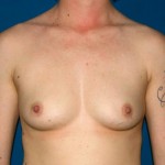 Breast Augmentation