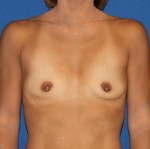 Breast Augmentation