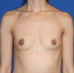 Breast Augmentation