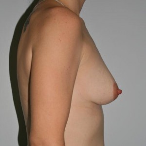 Breast Augmentation